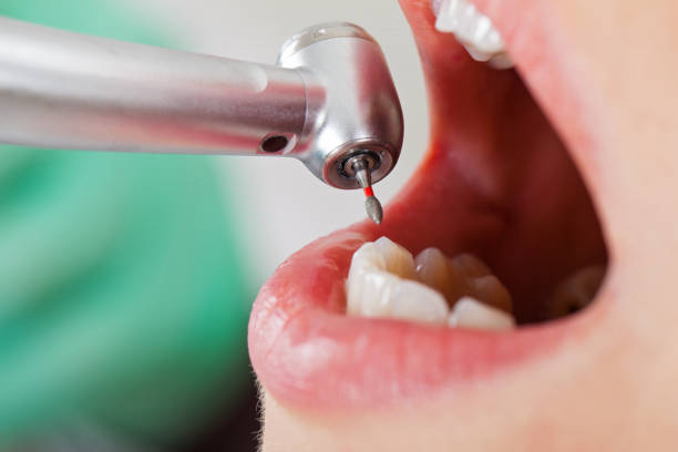 Best Emergency Dentist for Lost Fillings or Crowns in Preston, IA